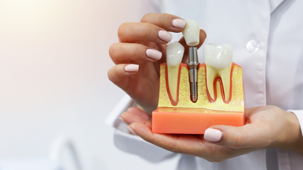 Dental Implants: A Permanent Solution for a Confident Smile